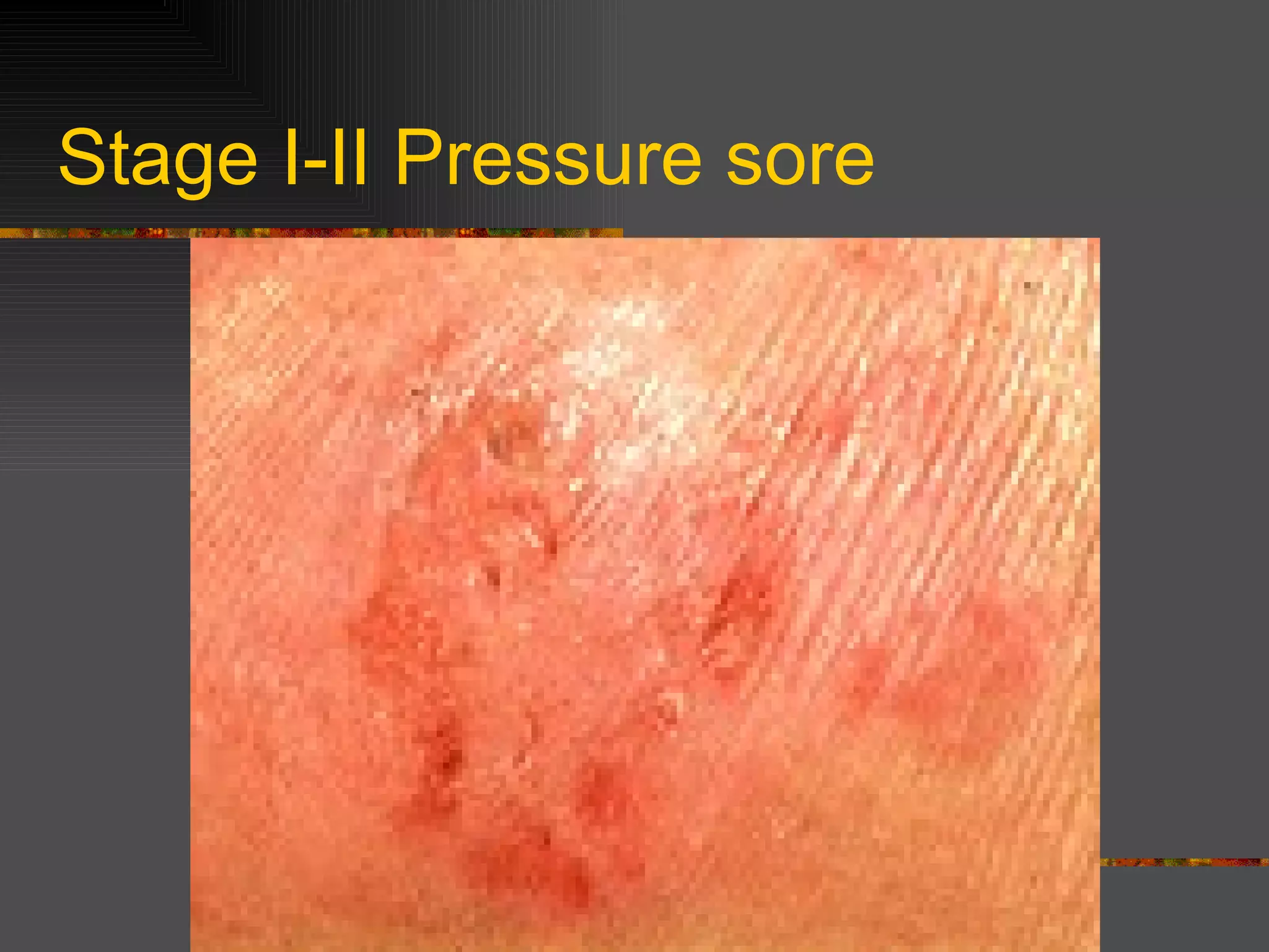 Pressure Sores