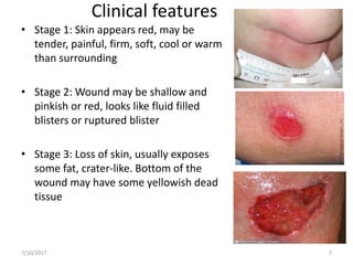Clinical features
• Stage 1: Skin appears red, may be
tender, painful, firm, soft, cool or warm
than surrounding
• Stage 2: Wound may be shallow and
pinkish or red, looks like fluid filled
blisters or ruptured blister
• Stage 3: Loss of skin, usually exposes
some fat, crater-like. Bottom of the
wound may have some yellowish dead
tissue
7/10/2017 7
 