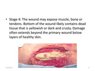 • Stage 4: The wound may expose muscle, bone or
tendons. Bottom of the wound likely contains dead
tissue that is yellowish or dark and crusty. Damage
often extends beyond the primary wound below
layers of healthy skin.
7/10/2017 8
 
