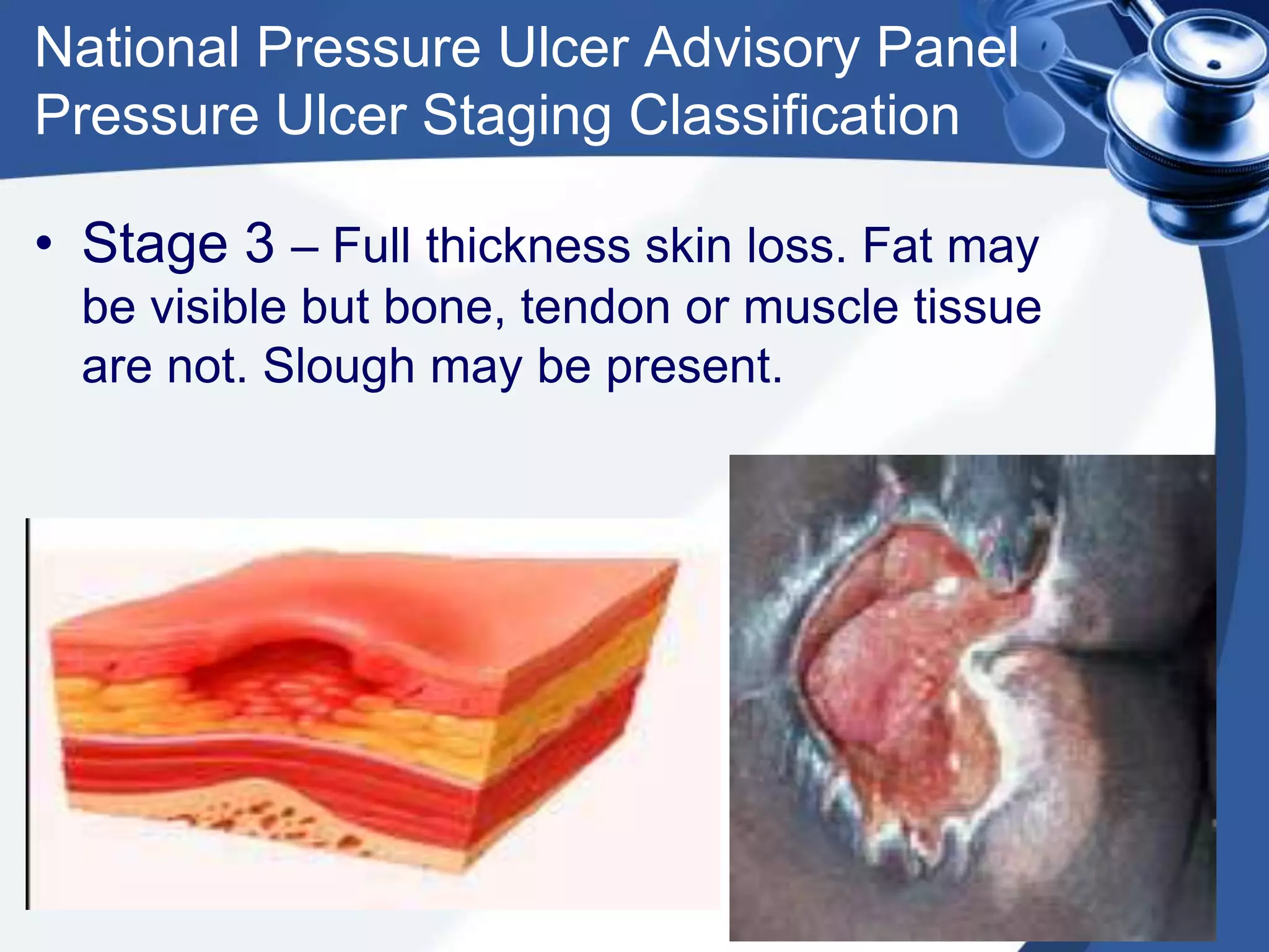 National Pressure Ulcer Advisory Panel
Pressure Ulcer Staging Classification
• Stage 3 – Full thickness skin loss. Fat may
be visible but bone, tendon or muscle tissue
are not. Slough may be present.
 