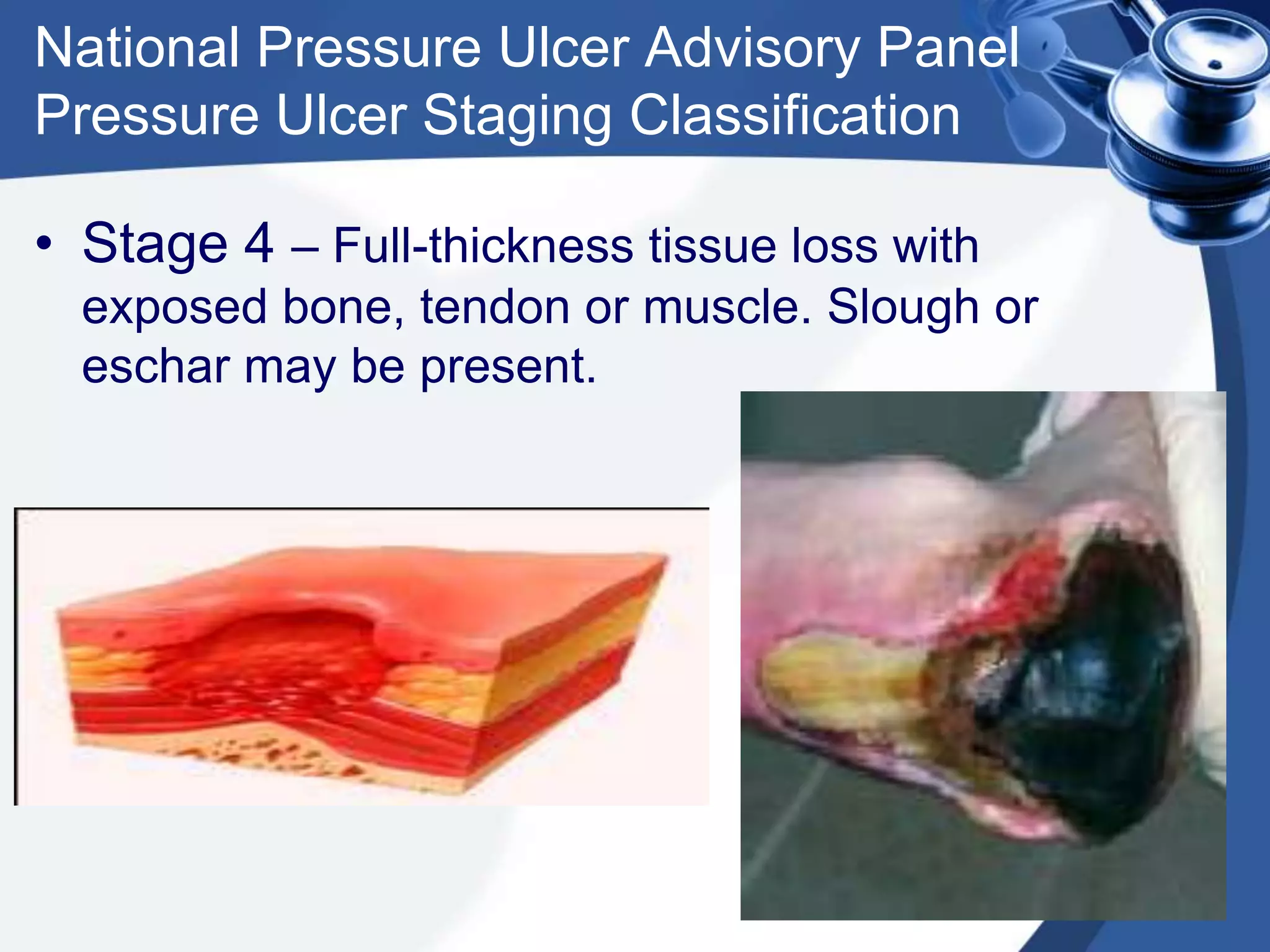 National Pressure Ulcer Advisory Panel
Pressure Ulcer Staging Classification
• Stage 4 – Full-thickness tissue loss with
exposed bone, tendon or muscle. Slough or
eschar may be present.
 