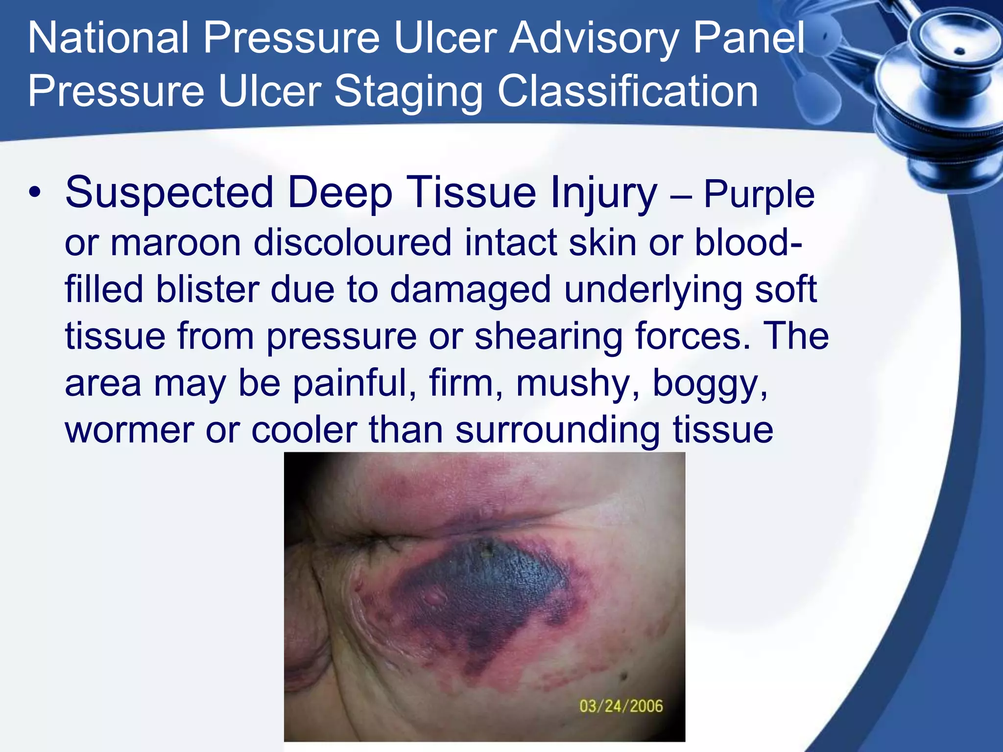 National Pressure Ulcer Advisory Panel
Pressure Ulcer Staging Classification
• Suspected Deep Tissue Injury – Purple
or maroon discoloured intact skin or blood-
filled blister due to damaged underlying soft
tissue from pressure or shearing forces. The
area may be painful, firm, mushy, boggy,
wormer or cooler than surrounding tissue
 
