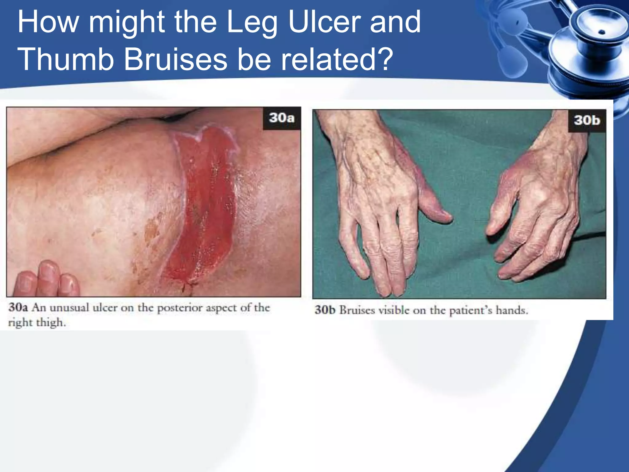 How might the Leg Ulcer and
Thumb Bruises be related?
 