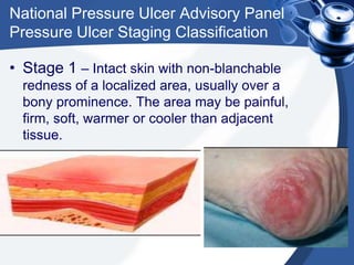 National Pressure Ulcer Advisory Panel
Pressure Ulcer Staging Classification
• Stage 1 – Intact skin with non-blanchable
redness of a localized area, usually over a
bony prominence. The area may be painful,
firm, soft, warmer or cooler than adjacent
tissue.
 
