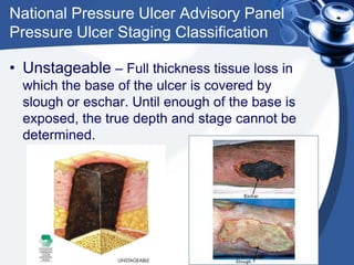 National Pressure Ulcer Advisory Panel
Pressure Ulcer Staging Classification
• Unstageable – Full thickness tissue loss in
which the base of the ulcer is covered by
slough or eschar. Until enough of the base is
exposed, the true depth and stage cannot be
determined.
 
