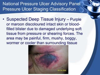 National Pressure Ulcer Advisory Panel
Pressure Ulcer Staging Classification
• Suspected Deep Tissue Injury – Purple
or maroon discoloured intact skin or blood-
filled blister due to damaged underlying soft
tissue from pressure or shearing forces. The
area may be painful, firm, mushy, boggy,
wormer or cooler than surrounding tissue
 