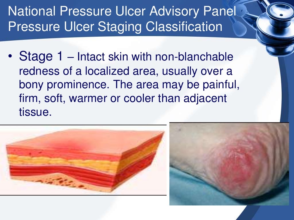 Pressure sores presentation