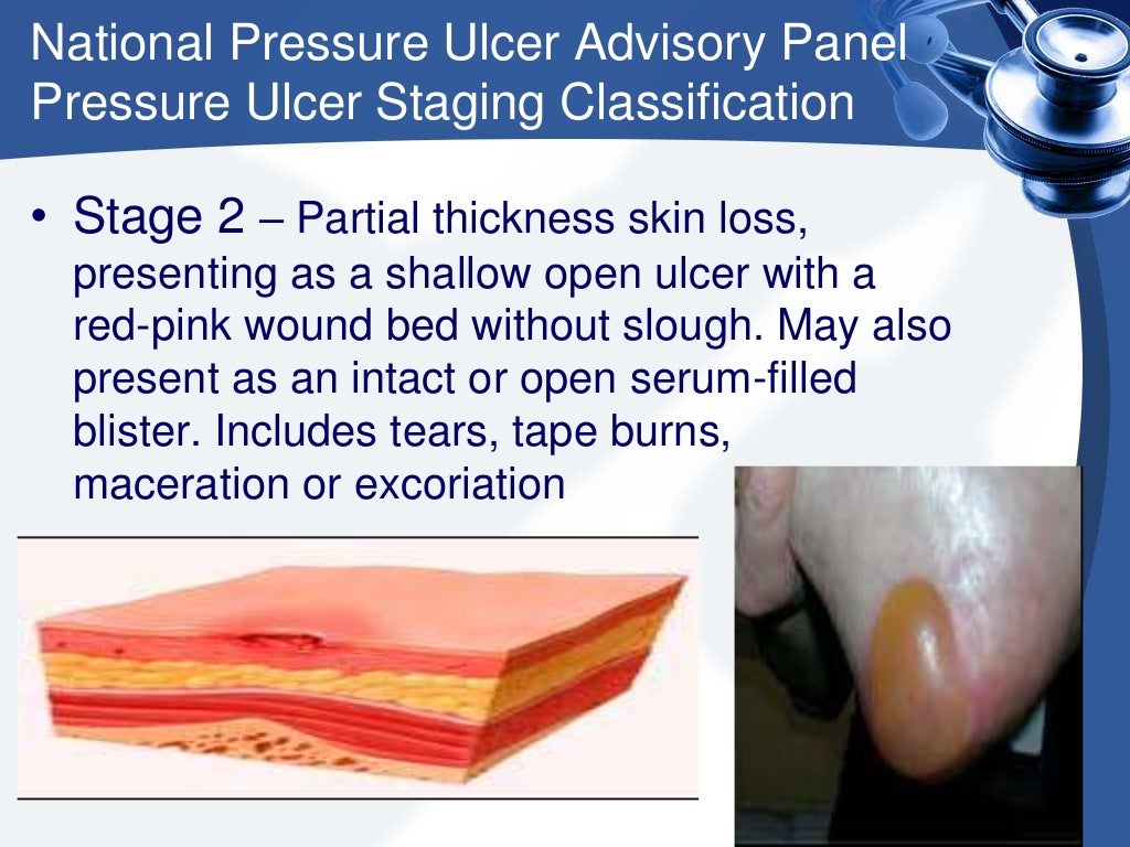 Pressure sores presentation
