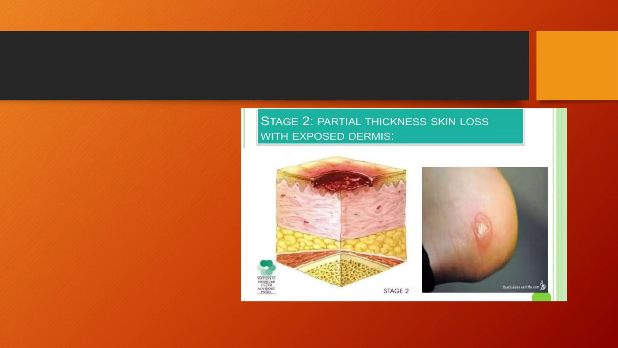 Pressure Sores Or Bedsore Prevention Pptx