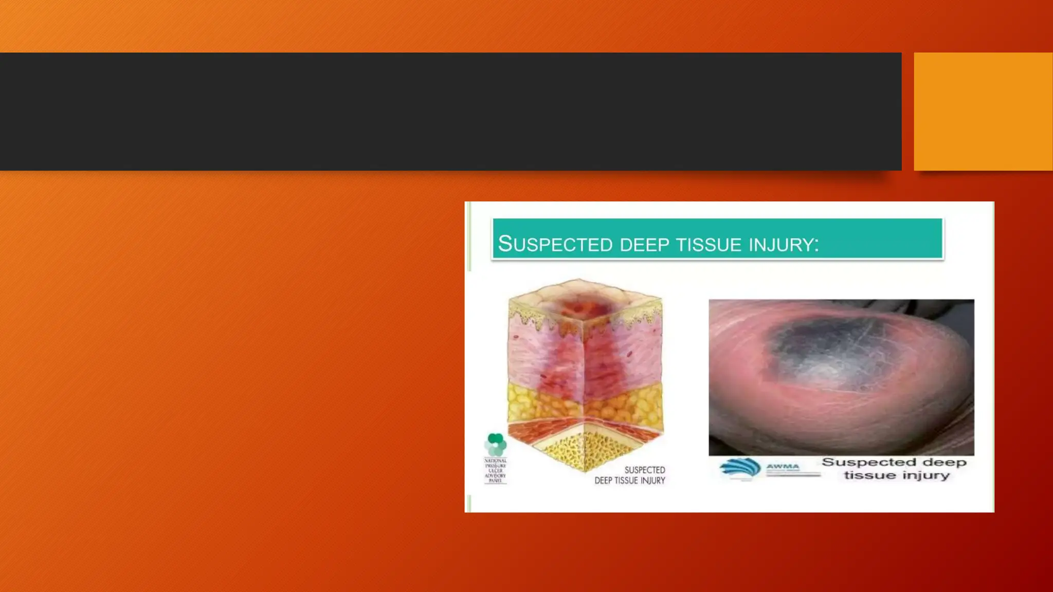 Pressure Sores Or Bedsore Prevention Pptx