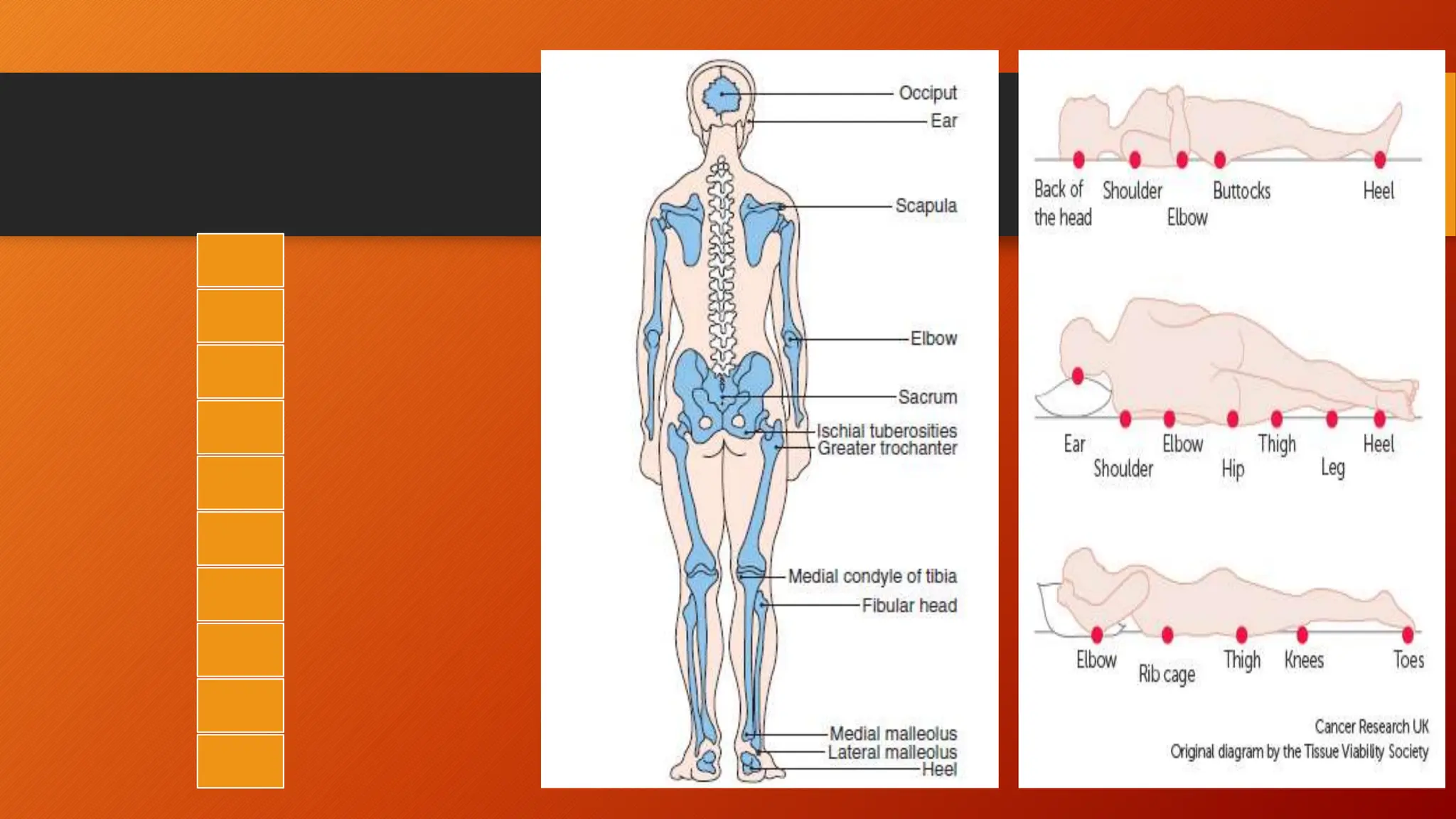 Pressure Sores Or Bedsore Prevention Pptx