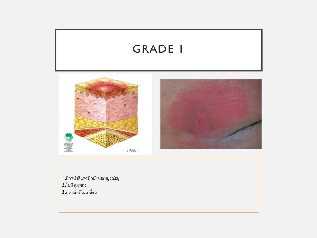 Pressure sore diagnosis and management for medical student