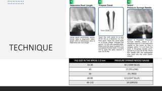 TECHNIQUE
FILE SIZE IN THE APICAL 1-2 mm PRESSURE SYRINGE NEEDLE GAUGE
15-30 30 ( DARK BLUE)
40 27 (YELLOW)
50 25 ( RED)
60-80 22 (LIGHT BLUE)
90-110 18 (GREEN)
 