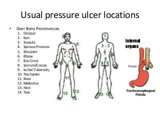Usual pressure ulcer locations
• Over Bony Prominences
1. Occiput
2. Ears
3. Scapula
4. Spinous Processes
5. Shoulder
6. Elbow
7. Iliac Crest
8. Sacrum/Coccyx
9. Ischial Tuberosity
10. Trochanter
11. Knee
12. Malleolus
13. Heel
14. Toes
Internal
organs
 