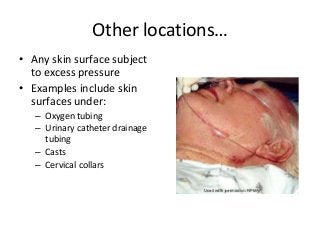 Other locations…
• Any skin surface subject
to excess pressure
• Examples include skin
surfaces under:
– Oxygen tubing
– Urinary catheter drainage
tubing
– Casts
– Cervical collars
 
