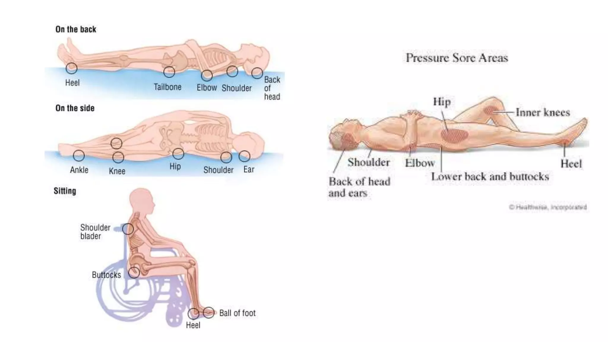 PRESSURE ULCER / BED SORE | PPTX