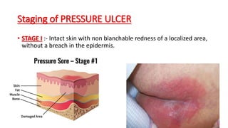 Staging of PRESSURE ULCER
• STAGE I :- Intact skin with non blanchable redness of a localized area,
without a breach in the epidermis.
 