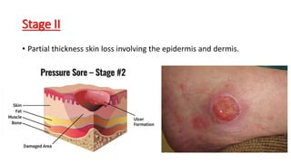 Stage II
• Partial thickness skin loss involving the epidermis and dermis.
 