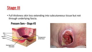 Stage III
• Full thickness skin loss extending into subcutaneous tissue but not
through underlying fascia.
 