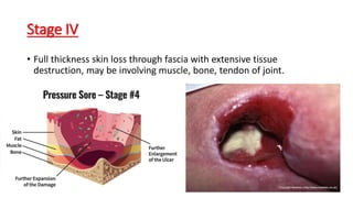 Stage IV
• Full thickness skin loss through fascia with extensive tissue
destruction, may be involving muscle, bone, tendon of joint.
 