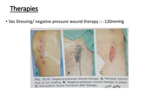 Therapies
• Vac Dressing/ negative pressure wound therapy :- -120mmHg
 