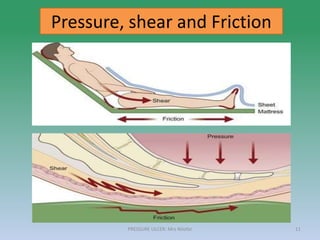 PRESSURE ULCER: Mrs Nilofar 11
Pressure, shear and Friction
 