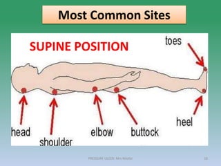 PRESSURE ULCER: Mrs Nilofar 16
Most Common Sites
SUPINE POSITION
 