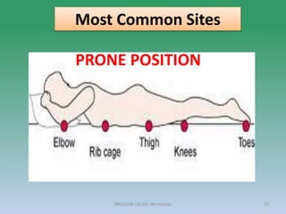PRESSURE ULCER: Mrs Nilofar 17
Most Common Sites
PRONE POSITION
 