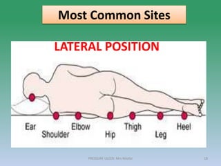 PRESSURE ULCER: Mrs Nilofar 18
Most Common Sites
LATERAL POSITION
 