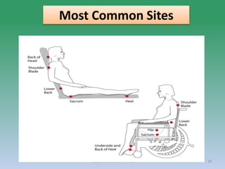 PRESSURE ULCER: Mrs Nilofar 19
Most Common Sites
 