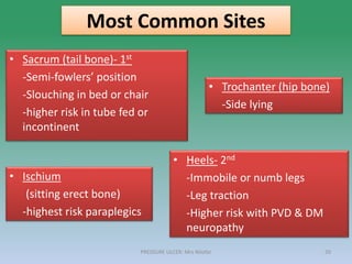 • Sacrum (tail bone)- 1st
-Semi-fowlers’ position
-Slouching in bed or chair
-higher risk in tube fed or
incontinent
Most Common Sites
PRESSURE ULCER: Mrs Nilofar 20
• Heels- 2nd
-Immobile or numb legs
-Leg traction
-Higher risk with PVD & DM
neuropathy
• Trochanter (hip bone)
-Side lying
• Ischium
(sitting erect bone)
-highest risk paraplegics
 