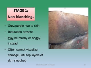 • Grey/purple hue to skin
• Induration present
• May be mushy or boggy
instead
• Often cannot visualize
damage until top layers of
skin sloughed
PRESSURE ULCER: Mrs Nilofar 23
STAGE 1:
Non-blanching.
 