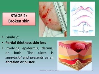 • Grade 2:
• Partial thickness skin loss
• involving epidermis, dermis,
or both. The ulcer is
superficial and presents as an
abrasion or blister.
STAGE 2:
Broken skin
PRESSURE ULCER: Mrs Nilofar 24
 