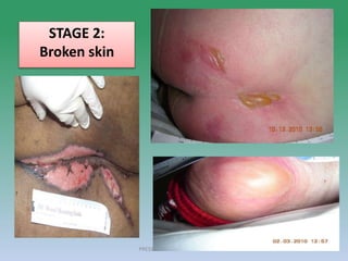 PRESSURE ULCER: Mrs Nilofar 25
STAGE 2:
Broken skin
 