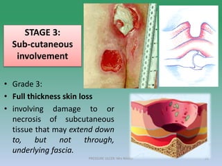 • Grade 3:
• Full thickness skin loss
• involving damage to or
necrosis of subcutaneous
tissue that may extend down
to, but not through,
underlying fascia.
STAGE 3:
Sub-cutaneous
involvement
PRESSURE ULCER: Mrs Nilofar 26
 