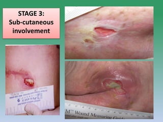 PRESSURE ULCER: Mrs Nilofar 27
STAGE 3:
Sub-cutaneous
involvement
 