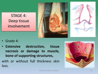 • Grade 4:
• Extensive destruction, tissue
necrosis or damage to muscle,
bone of supporting structures,
with or without full thickness skin
loss.
STAGE 4:
Deep tissue
involvement
PRESSURE ULCER: Mrs Nilofar 28
 