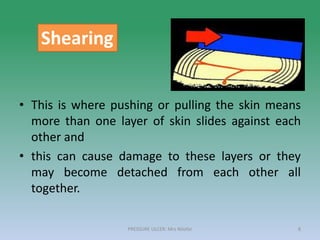 • This is where pushing or pulling the skin means
more than one layer of skin slides against each
other and
• this can cause damage to these layers or they
may become detached from each other all
together.
Shearing
PRESSURE ULCER: Mrs Nilofar 8
 