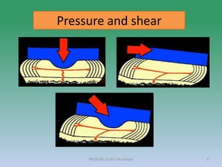 Pressure and shear
PRESSURE ULCER: Mrs Nilofar 9
 