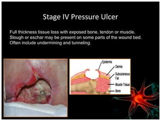 UNSTAGEABLEStage I Pressure UlcerIntact skin with non-blanchable redness of a localized area usually over a bony prominence. Darkly pigmented skin may not have visible blanching; its color may differ from the surrounding area.