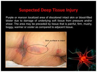  Off load area of pressure ulcer with  pressure reducing / distribution surface and turning and repositioning schedule.Stage I on Heels – Ensure that heel(s) are floated at all times with frequent monitoring.Stage II Pressure UlcerPartial thickness loss of dermis presenting as a shallow open ulcer with a red pink wound bed, without slough. May also present as an intact or open/ruptured serum-filled blister.