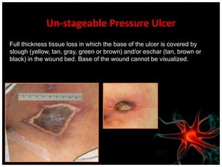 Off load area of pressure ulcer with  pressure reducing / distribution surfaces and turning and repositioning schedule.Minimal DrainageCleanse with normal saline, apply hydrocolloid dressing every three days and PRN soiling or dislodging. Monitor placement every day.Stage III Pressure UlcerFull thickness tissue loss. Subcutaneous fat may be visible but bone, tendon or muscles are not exposed. Slough may be present but does not obscure the depth of tissue loss. May include undermining and tunneling