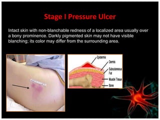 Common Pressure Ulcers sitesSupine:23% sacro-coccygeal8% heels1% occiput; spineSitting:24% ischium3% elbowsLateral:15% trochanter7% malleolus6% knee3% heels