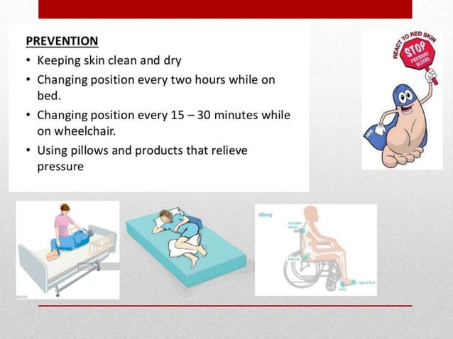 Pressure ulcer assessment prevention & reporting | PPTX