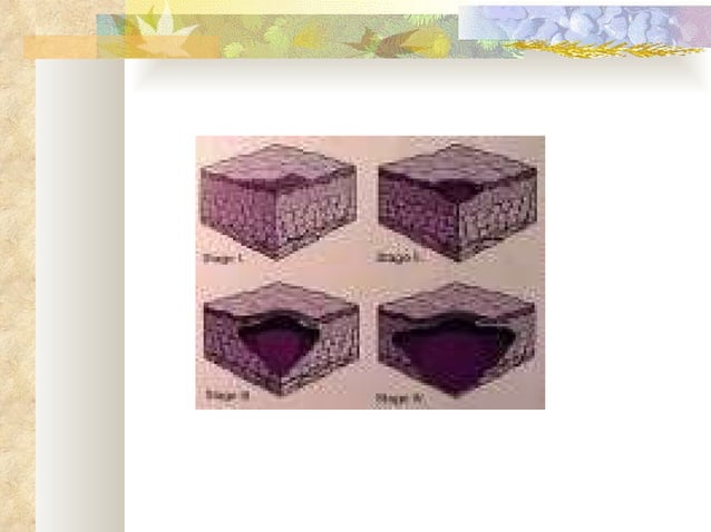 Pressure Ulcer Prevention & Skin Care | PPT | Skin and Dermatology ...
