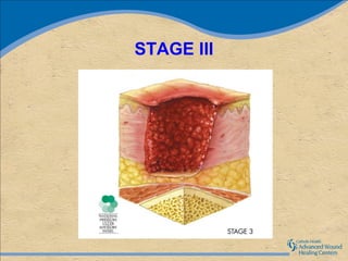STAGE III
 
