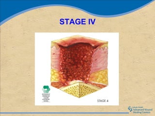 STAGE IV
 