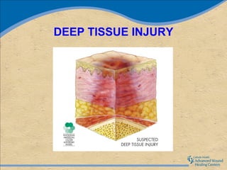DEEP TISSUE INJURY
 