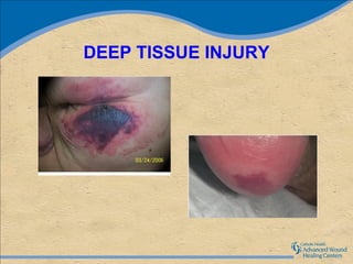 DEEP TISSUE INJURY
 