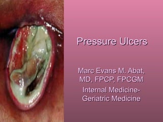 Pressure Ulcers

Marc Evans M. Abat,
MD, FPCP, FPCGM
 Internal Medicine-
 Geriatric Medicine
 